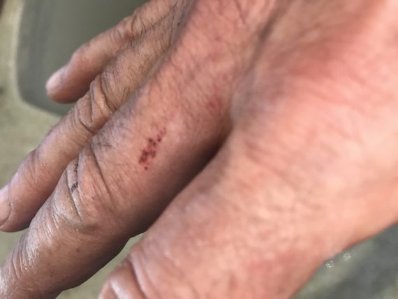 dog bite to the hand
